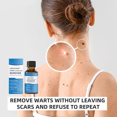 Natural wart and mole removal liquid with precision dropper for targeted application.
