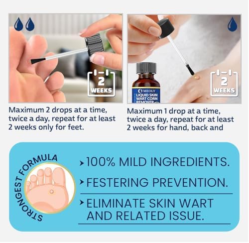 Applying MEOLY fast-acting liquid to a plantar wart for effective removal
