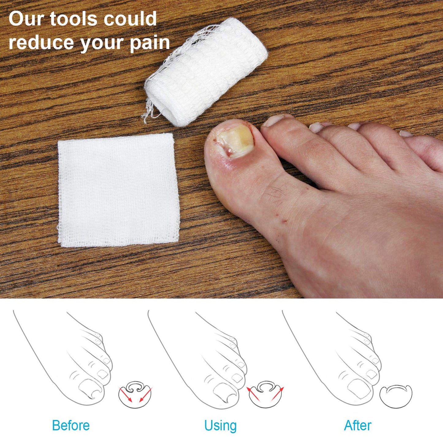Close up of gold ingrown toenail corrective clamp
