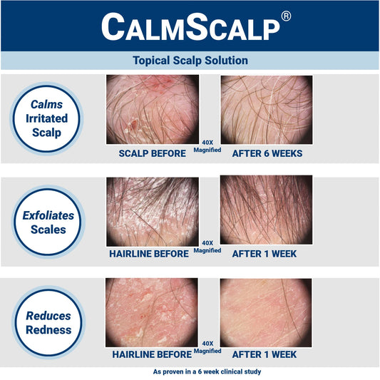 CalmScalp scalp solution bottle with applicator tip