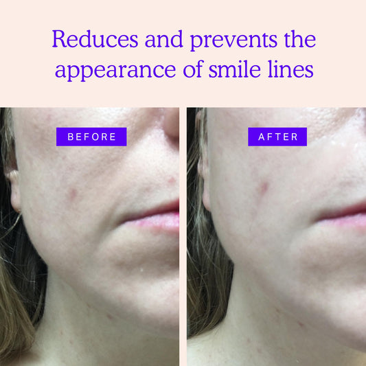 BLUMBODY non silicone face patches applied around the mouth to smooth laugh lines