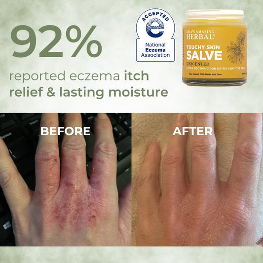 Ora's Amazing Herbal natural sensitive skin treatment cream packaging