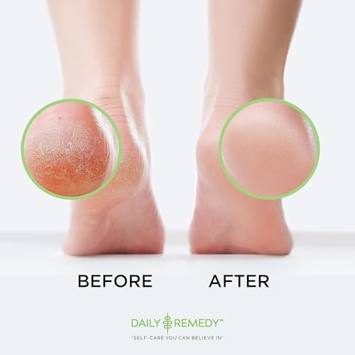 Close up of Daily Remedy callus gel precision applicator cap for easy use.
