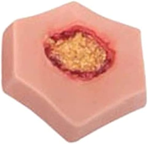 Close up of stage four necrotic ulcer on LUCKFY medical model.