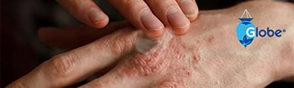 Globe brand first aid ointment for soothing rashes and skin inflammation.