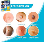 MEOLY fast acting wart removal packaging showing 17 percent salicylic acid concentration.
