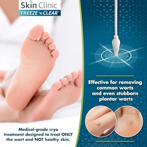 The complete components of the Skin Clinic wart remover kit including standard and ultra-precise tips.