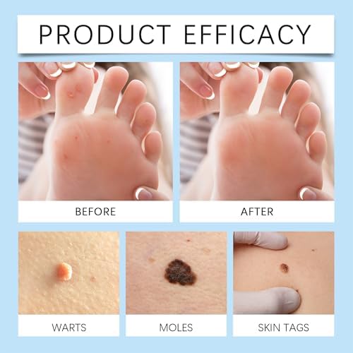 Liwoci fast acting skin tag remover serum for face and body use.