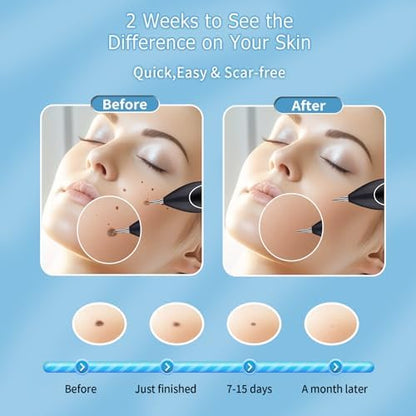 GJW skin clinic removal kit including fifteen precision needles and probes