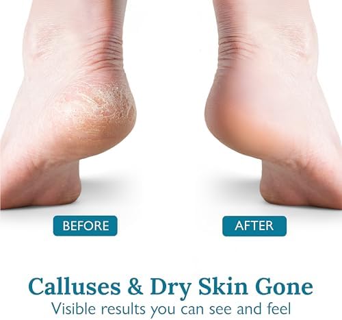 Gilden Tree 40 percent urea cream for feet maximum strength exfoliation and moisturizing.