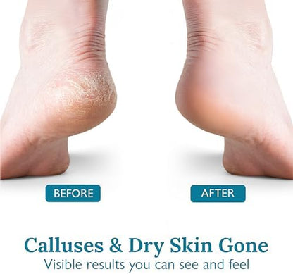 Gilden Tree 40 percent urea cream for feet maximum strength exfoliation and moisturizing.
