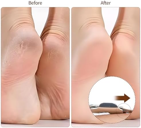 Ergonomic non slip handle of the Bolsdoic foot care tool close up view