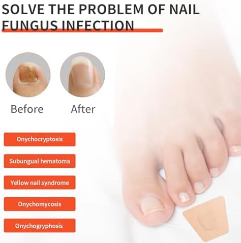 Overnight fungal nail renewal patch application on a toenail for repair.