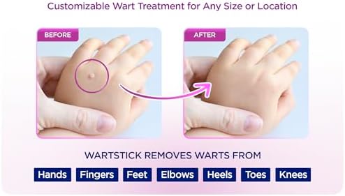 WartStick 40 percent salicylic acid solid stick applicator for plantar warts.