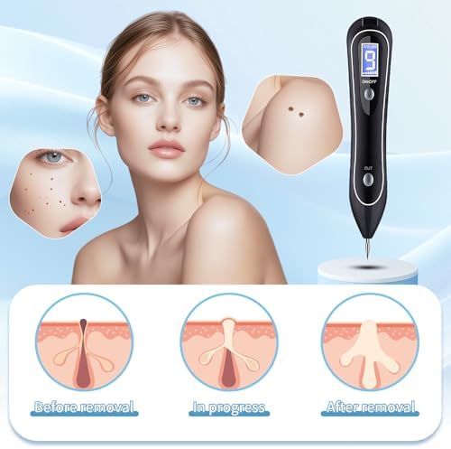 Handheld skin tag remover pen with LCD display and intensity buttons