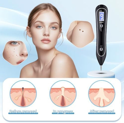 Handheld skin tag remover pen with LCD display and intensity buttons