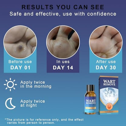Side view of GYOURFF 0.5 ounce liquid wart treatment for clear skin.