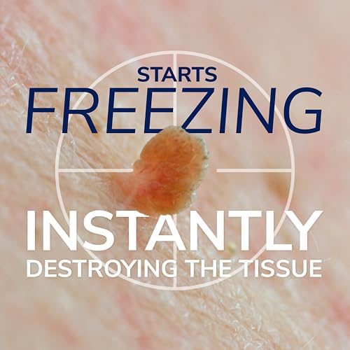 Close-up of the foam applicator tip for precise skin tag freezing treatment.