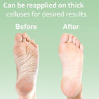 Dr. Entre's foot care gel being applied to callused heel area.
