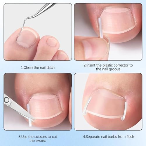 Breathable corrector strips and elastic curved patches included in the Ketsicart ingrown nail treatment routine.