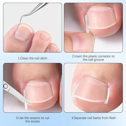 Breathable corrector strips and elastic curved patches included in the Ketsicart ingrown nail treatment routine.