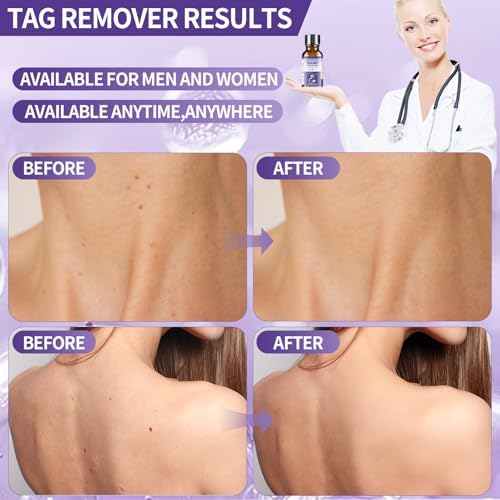 Dermatologist recommended liquid formula for flat wart removal
