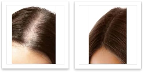 Person using Caboki hair powder on thinning hairline