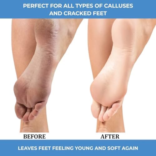 Close up of the no drip callus remover gel texture for professional foot care.