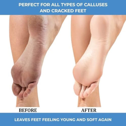 Close up of the no drip callus remover gel texture for professional foot care.