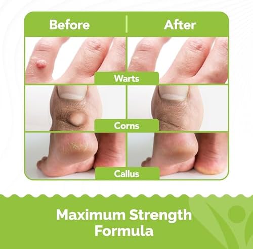 Samsali 20ml salicylic acid solution for removing flat warts and skin calluses