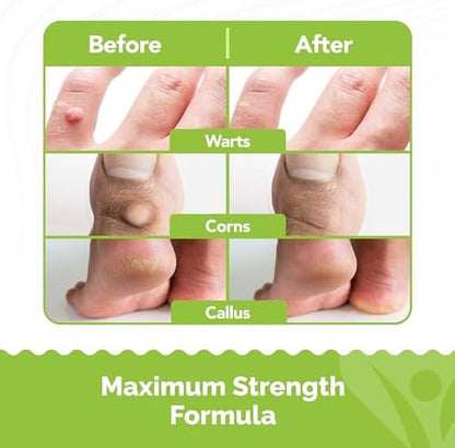 Samsali 20ml salicylic acid solution for removing flat warts and skin calluses