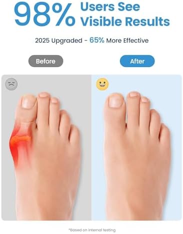 Close up of Zebroc bunion relief toe spacers for alignment