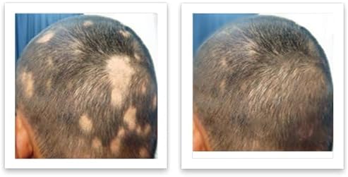 Before and after results of Caboki 10X volumizing powder
