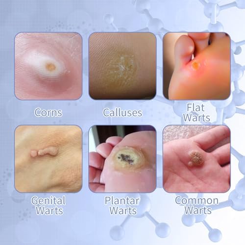 3-in-1 fast acting wart remover solution packaging showing natural herbal extract benefits.