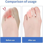 Trimmable silicone toe caps being applied to foot for callus protection