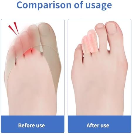 Trimmable silicone toe caps being applied to foot for callus protection