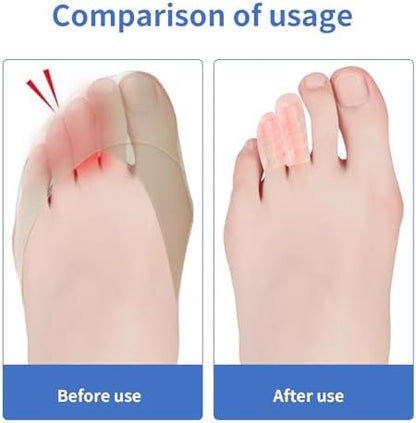Trimmable silicone toe caps being applied to foot for callus protection