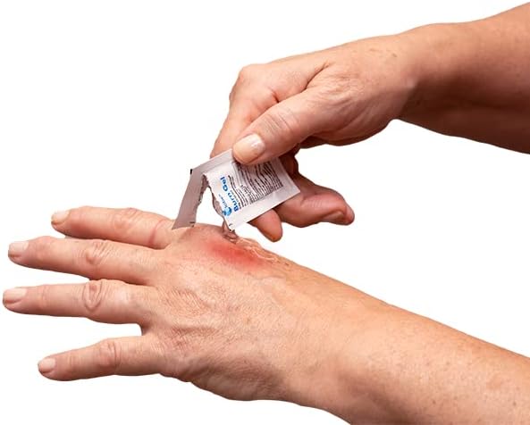 Globe burn gel with Aloe Vera packets being applied to a minor skin scald.
