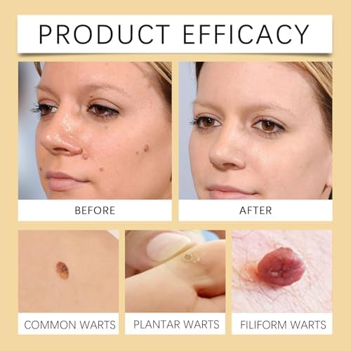 MORKORIA wart remover packaging showing 17 percent salicylic acid concentration