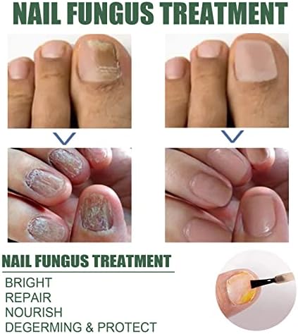 Unbranded 30ml nail repair liquid for discolored nails