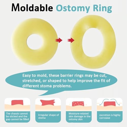Close up of a moldable hydrocolloid ring being stretched for custom stoma fit.