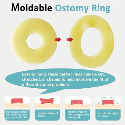 Close up of a moldable hydrocolloid ring being stretched for custom stoma fit.