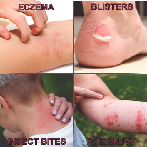 Quatriderm NF maximum strength hydrocortisone for psoriasis and dermatitis