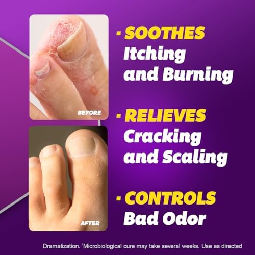 Clinical anti-fungus foot treatment cream by Silka for ringworm remedy.