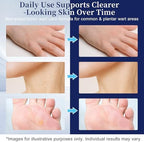 Imported USA skincare treatment for effective wart and skin tag removal