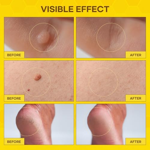 SupreH Botanical Skin Restore Cream tube included in the maximum strength wart kit.