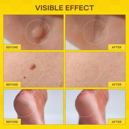 SupreH Botanical Skin Restore Cream tube included in the maximum strength wart kit.
