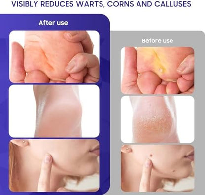 Fast-acting film forming wart remover liquid showing the protective barrier on skin.