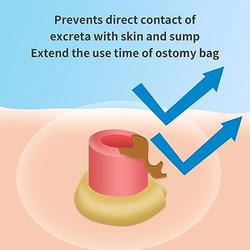 Ovand ostomy adhesive skin protectant paste for leak prevention