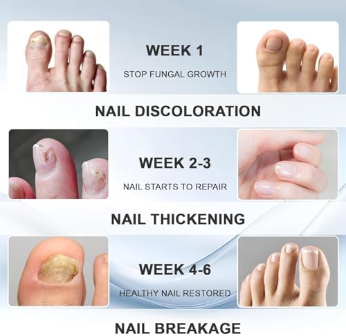 Step by step application of fungal nail treatment on discolored toenails.